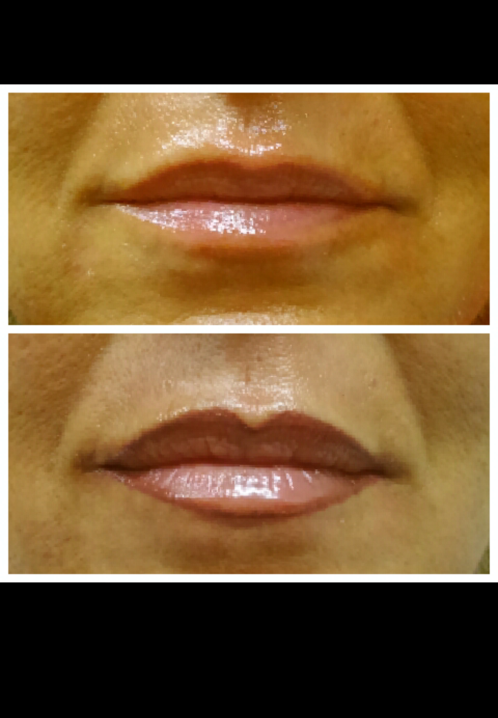 Antes y depsues del perfil de labios